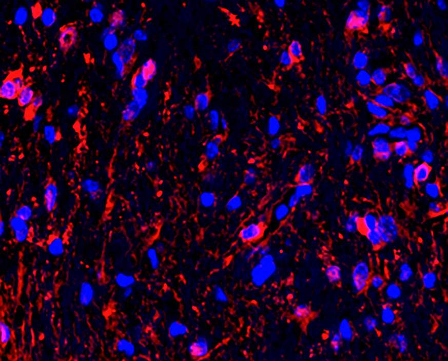 Picture of red and blue spots representing vision-threatening optic nerve gliomas on a black background