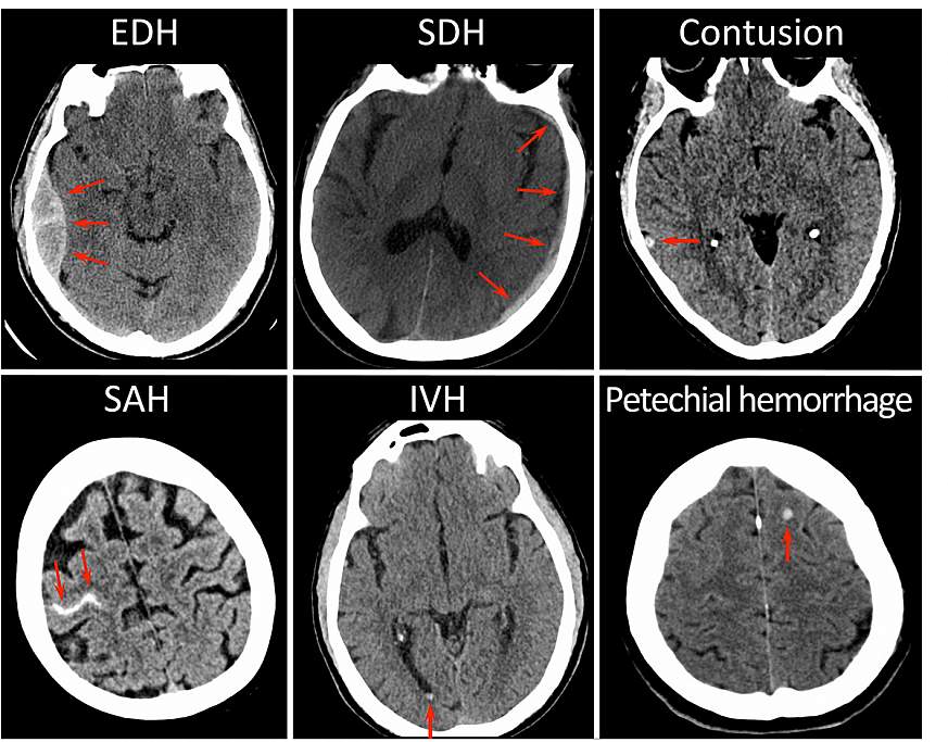 Images of brain CT scans taken after mild head injury
