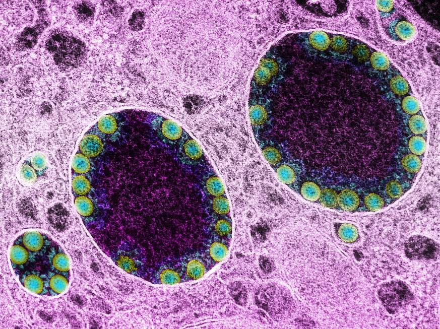 Transmission electron micrograph of SARS-CoV-2 virus particles (green) within endosomes of a heavily infected nasal Olfactory Epithelial Cell. 