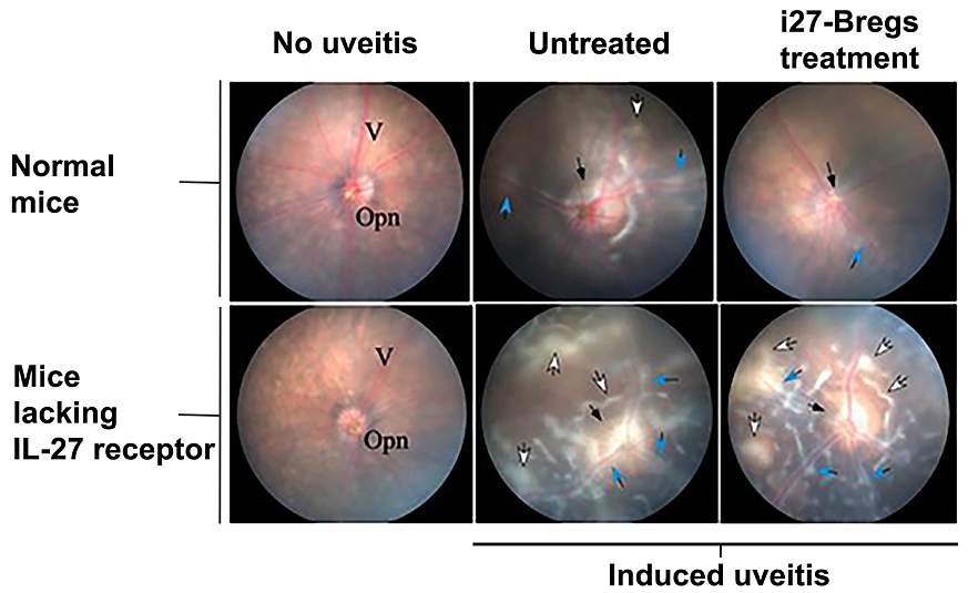 Photographs of mouse retina showing the effect of uveitis treatment with i27-Bregs. The left column represents a normal retina. Photos in the middle and right column are retinal images from mice with uveitis, untreated  or treated with i27-Bregs. The cent
