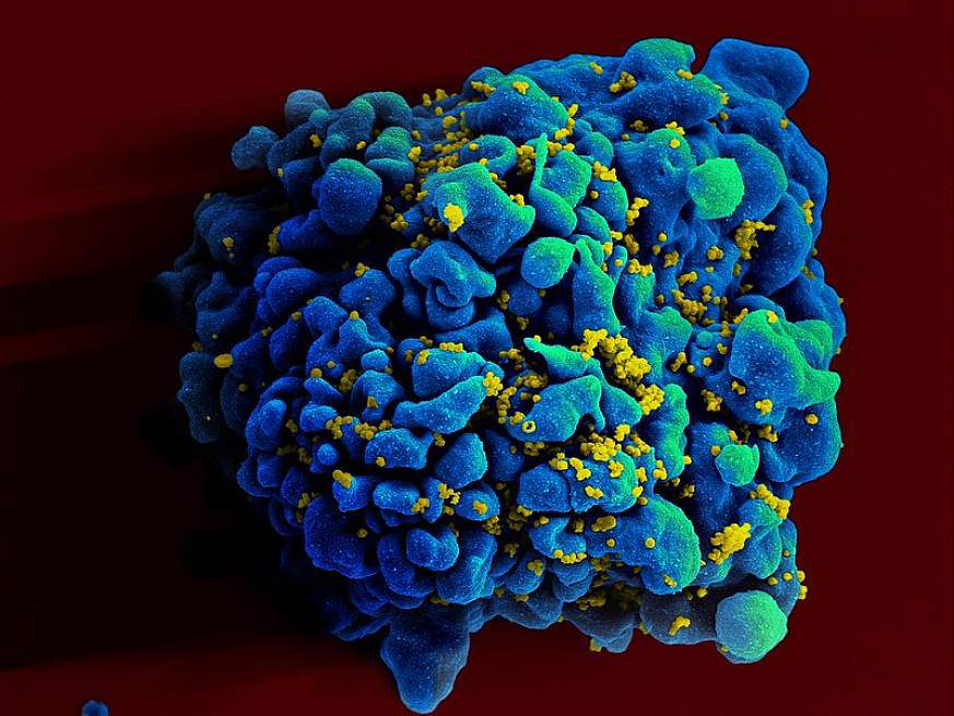 Scanning electromicrograph of an HIV-infected H9 T cell. 