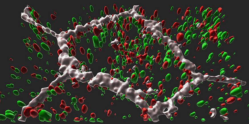 3D illustration of L-ORD patient RPE cell