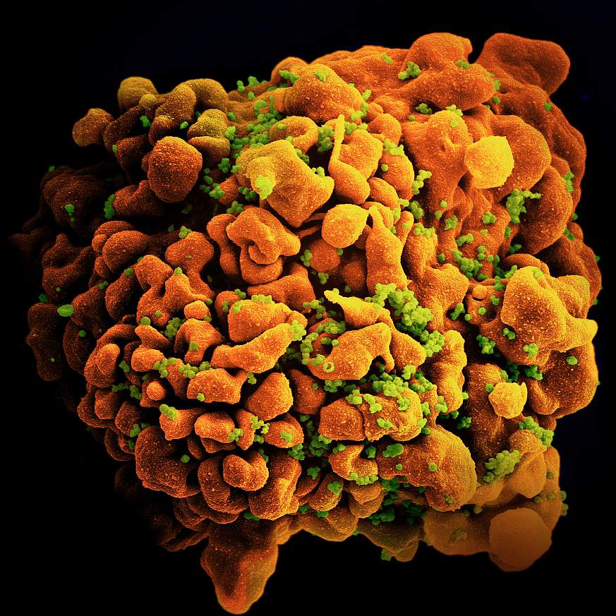 HIV-infected H9 T Cell