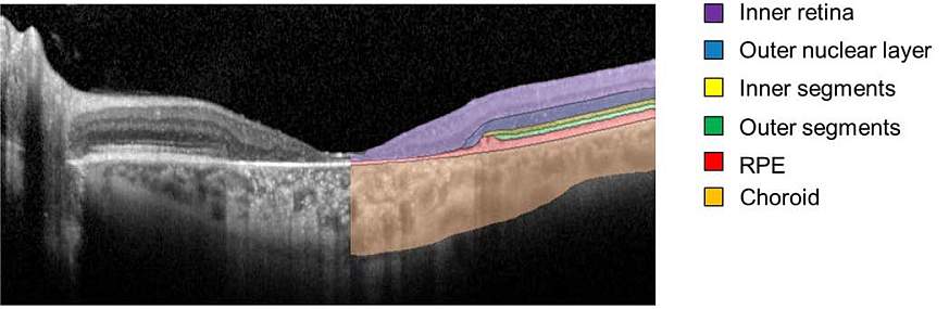 Spectral-domain optical coherence tomography of layers of the retina