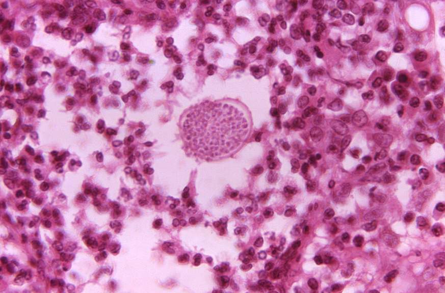 A photomicrograph of a tissue sample from a patient with Valley Fever. 