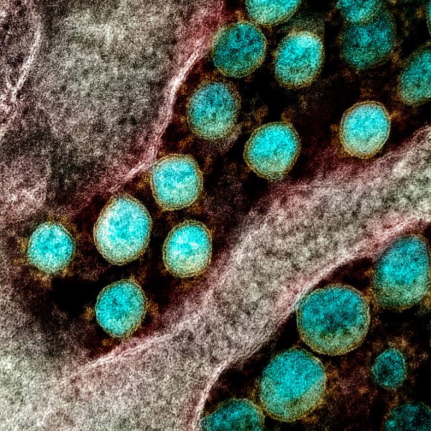  Transmission electron micrograph of SARS-CoV-2 virus particles, isolated from a patient.