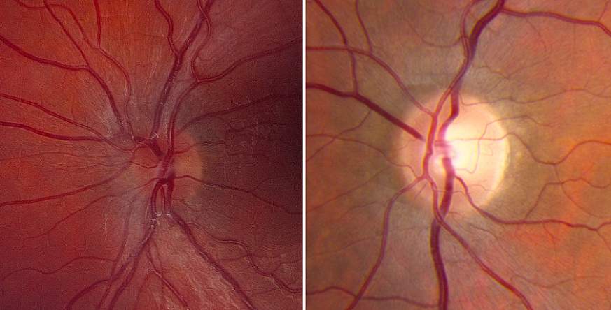 Image of diseased and normal optic nerve heads