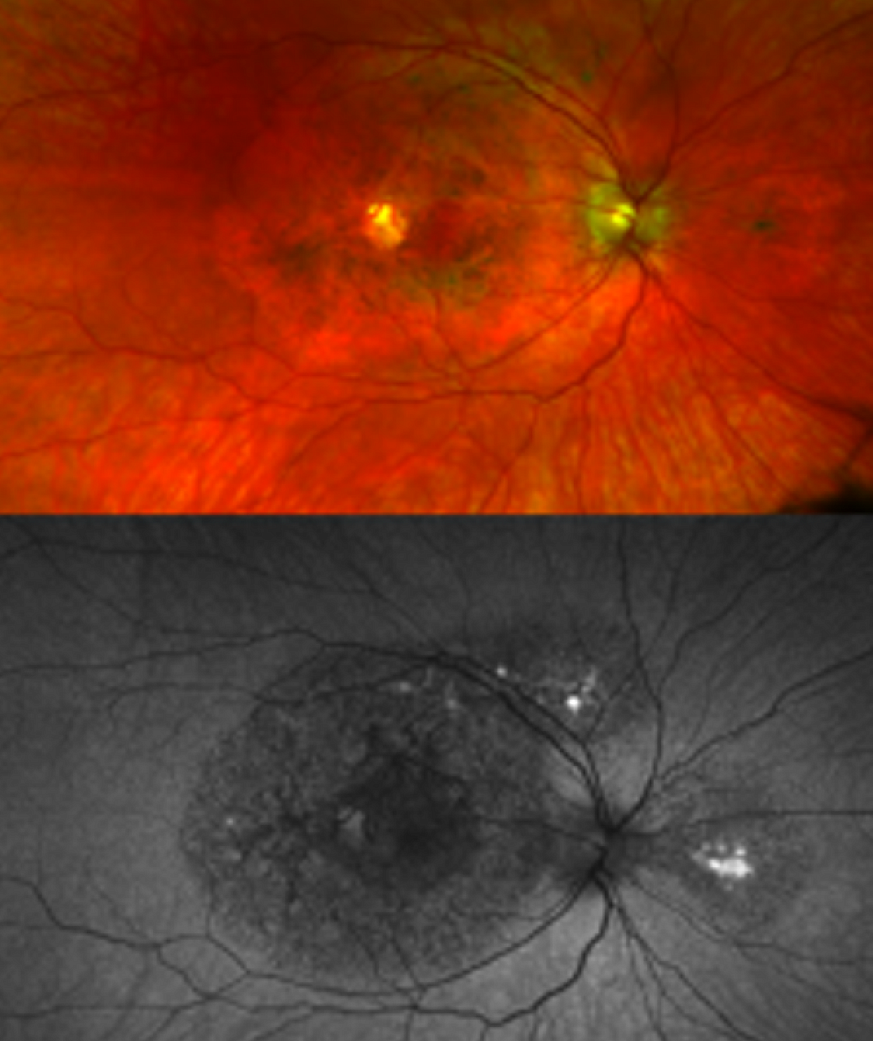 Retinal images of a patient with a TIMP3 mutation
