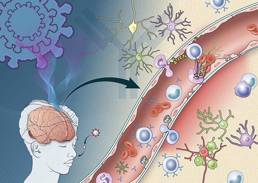 Illustration of COVID-19 damage to the brain.