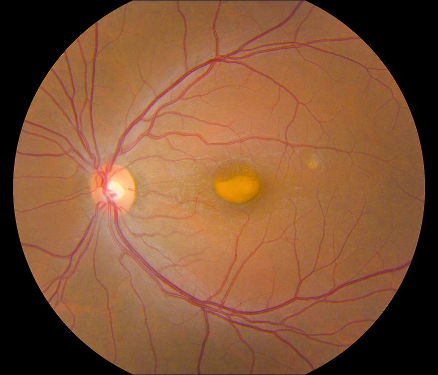 Image of a retina in a person with VMD