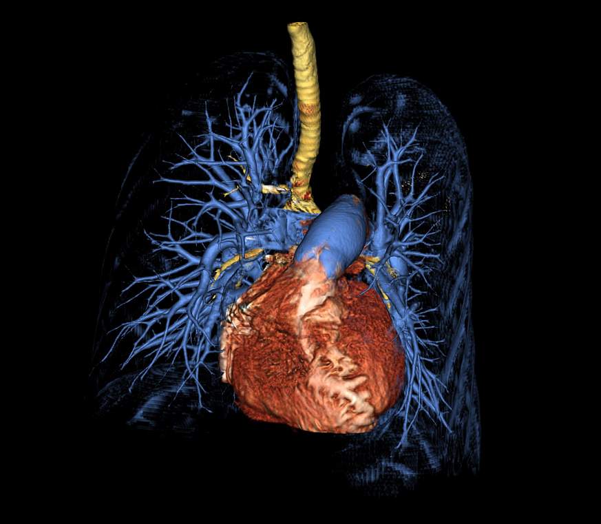 Image of a 3D rendering of the lungs and heart 