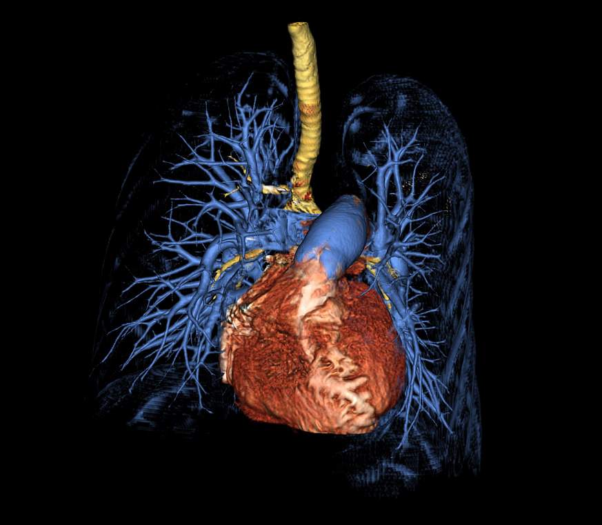 pulmonary artery hypertension