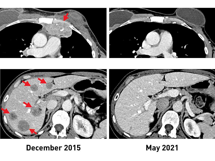 CT scans showing metastatic lesions before and after TIL therapy 