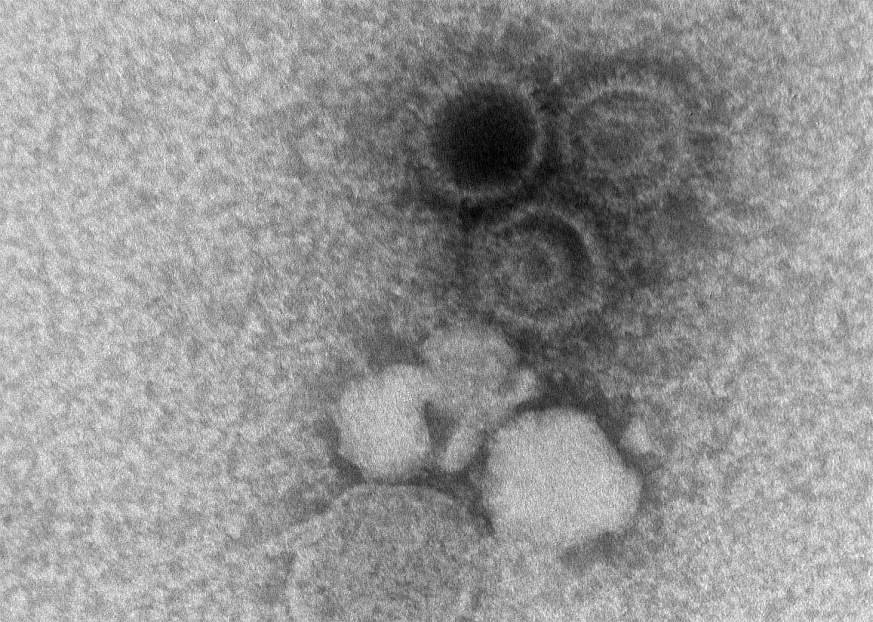 Photo taken with microscope of Epstein-Barr virions in black and white