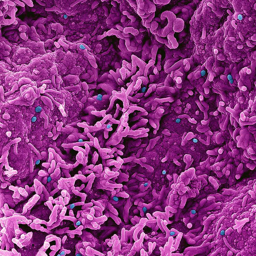 Monkeypox Virus Colorized scanning electron micrograph of monkeypox virus (blue) on the surface of infected VERO E6 cells (pink).