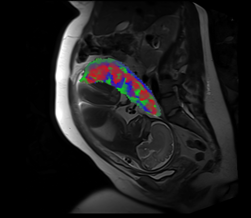Image of a placental MRI scan
