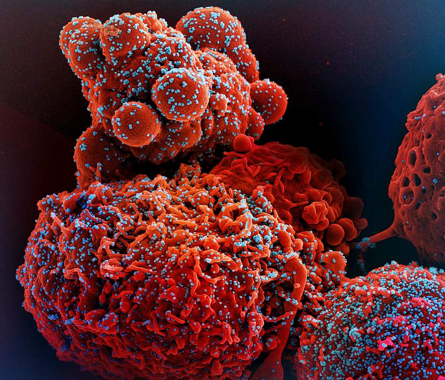 Colorized scanning electron micrograph of a cell (red) infected with the Omicron strain of SARS-CoV-2 virus particles (blue), isolated from a patient sample.
