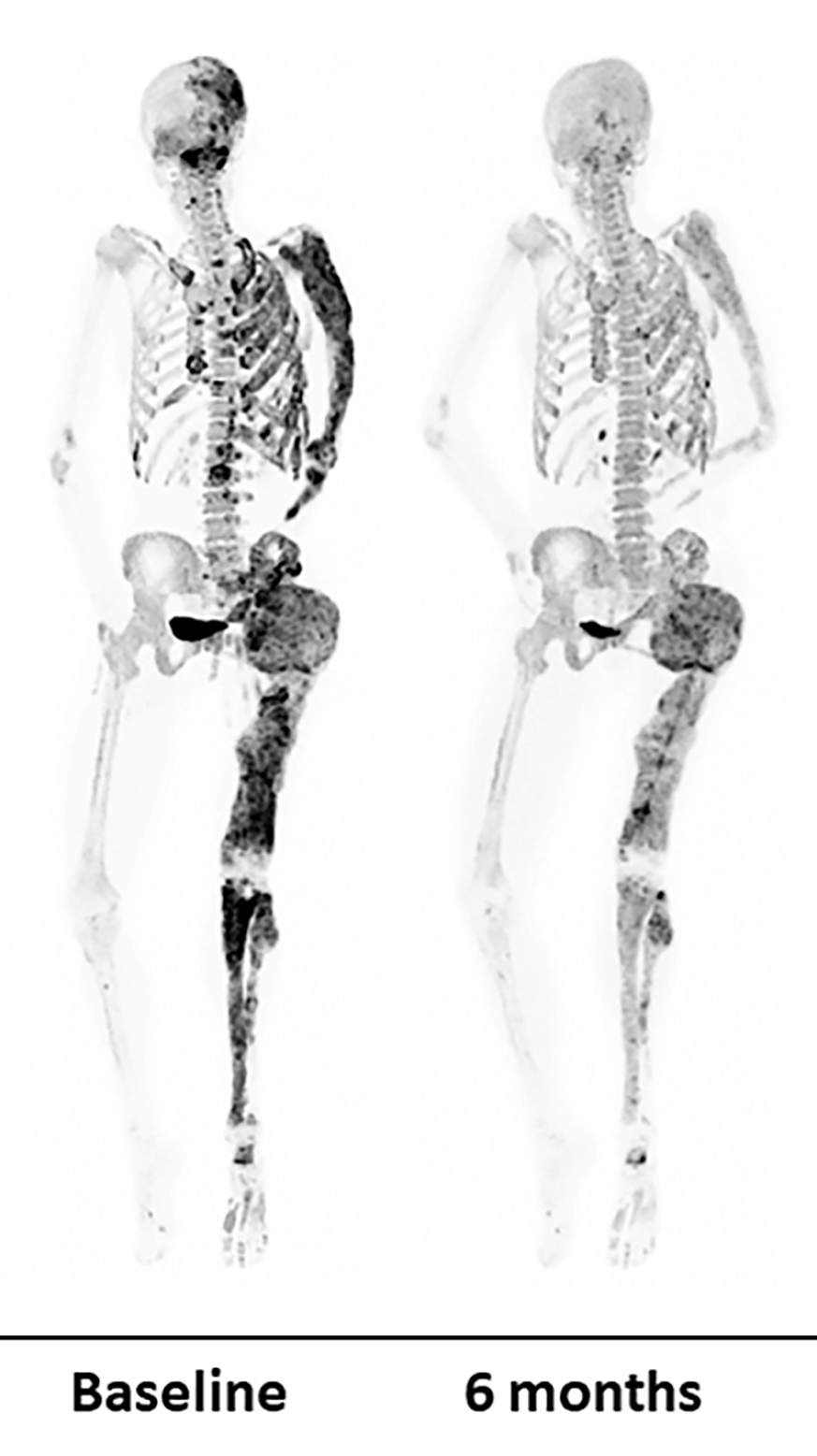 Before and after bone scans