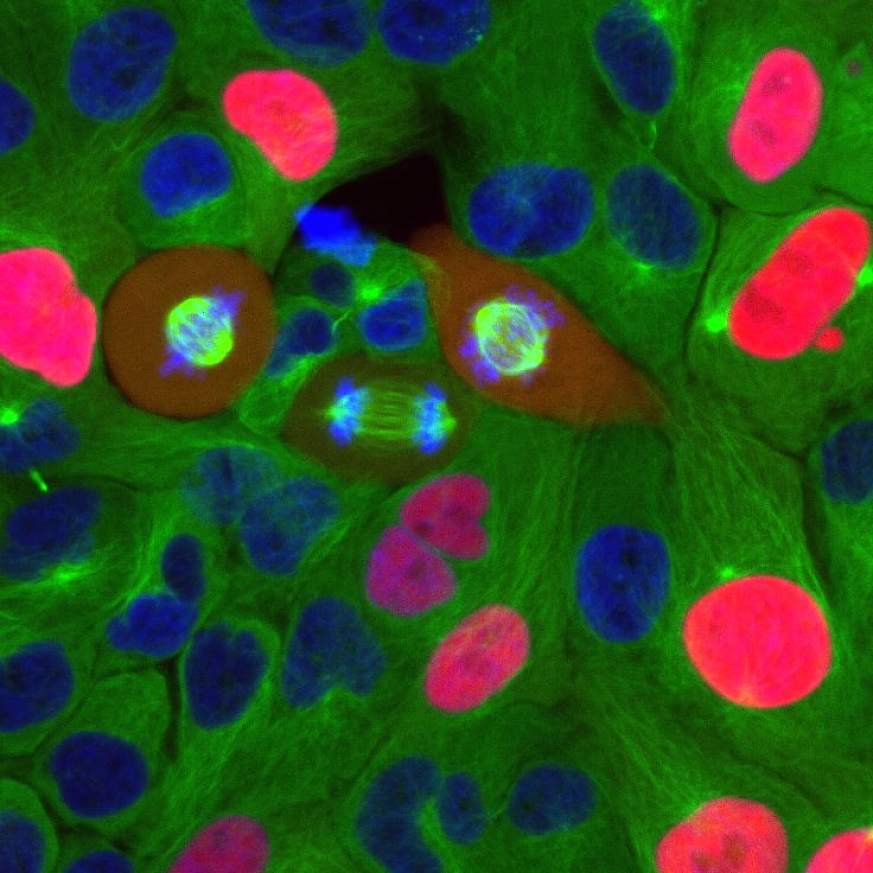 Microscope image of breast cancer cells in the process of dividing.