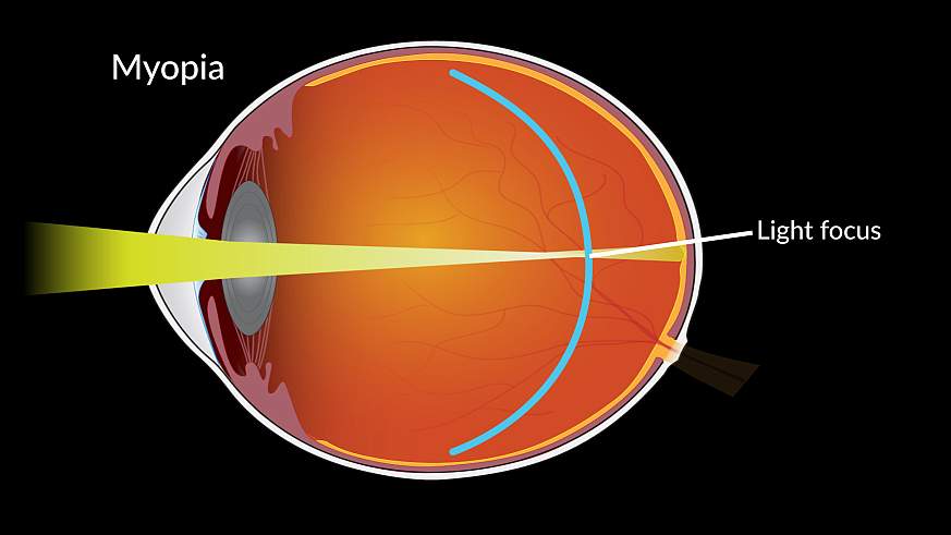 Diagram of an eye with myopia