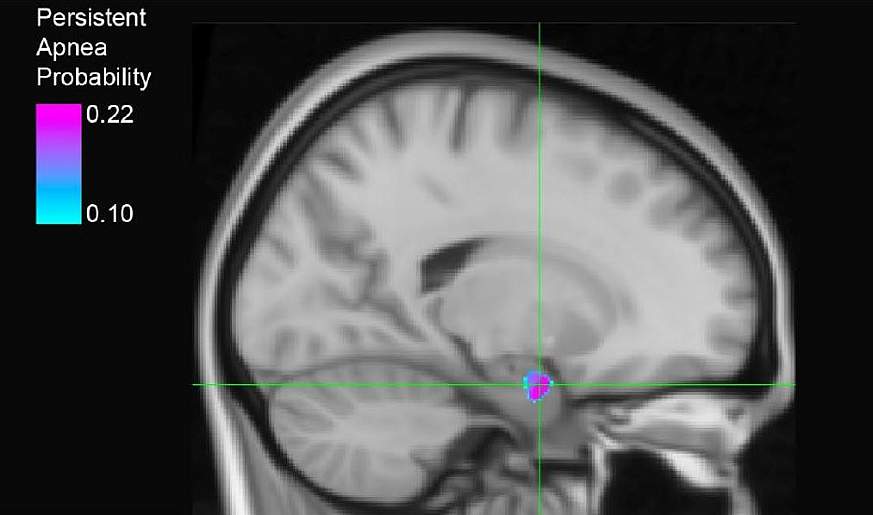 Image of brain region showing the probability of persistent apnea