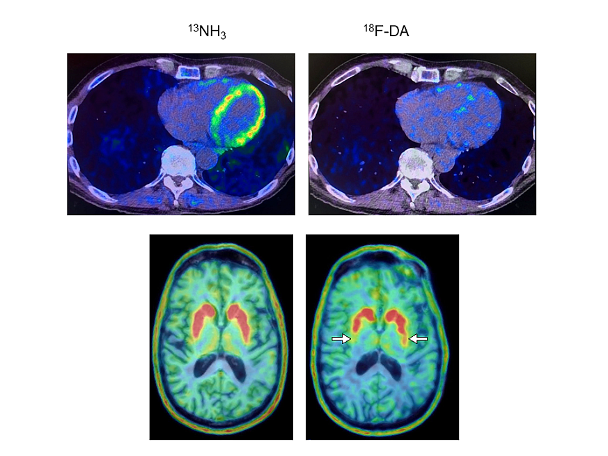 Heart and brain PET scans from a study participant