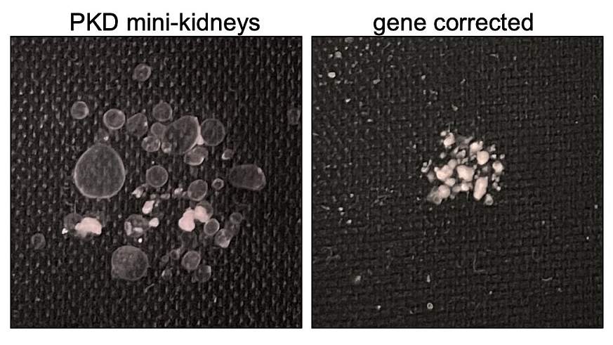  Two photos of tissue chips. The one on the left shows mini-kidneys with homozygous PKD mutations, the one on the right shows gene-corrected heterozygotes. 