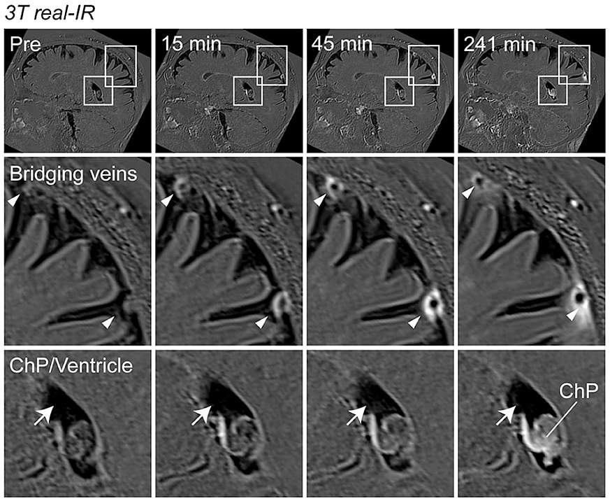 A series of MRI images showing the movement of light-emitting molecules moving through the arachnoid barrier. 