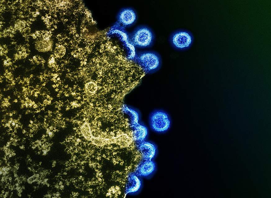 Image of a blue HIV virus particle emerging from a yellow, globular-shaped H9 T cell 
