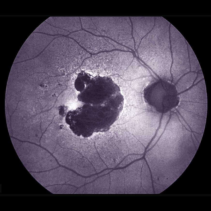 Inflammation-reducing drug shows no benefit for dry age-related macular  degeneration in NIH trial