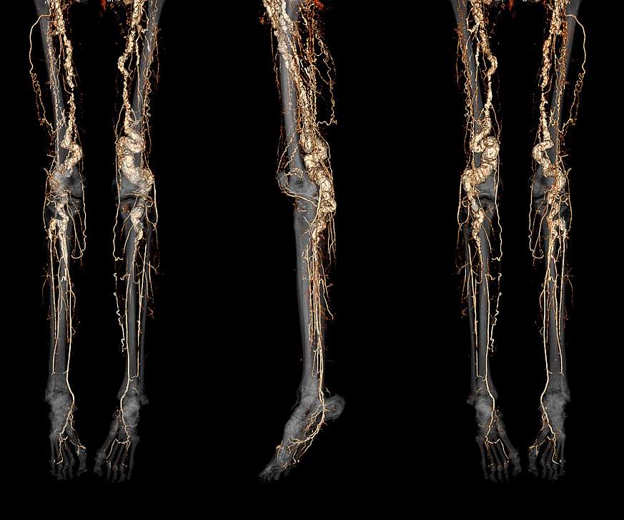 A CT angiography scan of a person with ACDC disease showing abnormal calcification of the blood vessels in the legs and feet. 