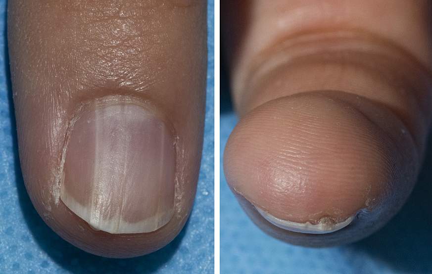A fingernail with onychopapilloma. 