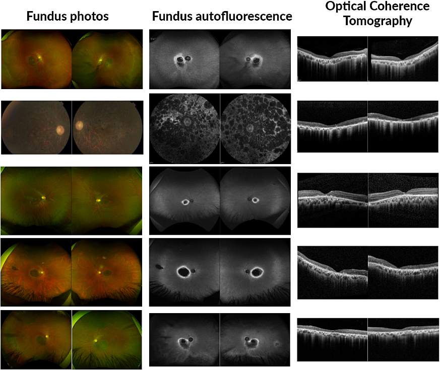 Images of multiple forms of retinal dystrophy from the study