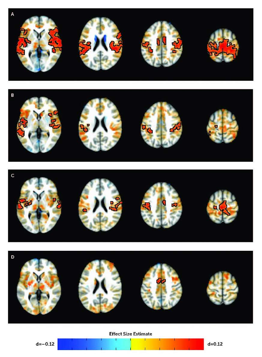 Image showing differences in subcortico-cortical connectivity in youth with and without ADHD.