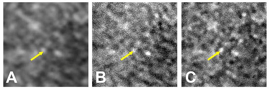 3 slides of retina tissue taken using three separate imaging techniques. Each image gets progressively clearer.