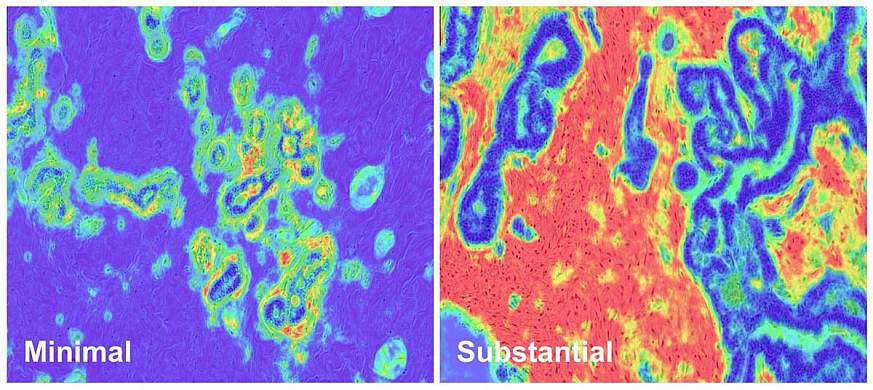 Slides showing minimal disruption (left) and substantial disruption (right) in breast stromal tissue. Slides showing minimal disruption (left) and substantial disruption (right) in breast stromal tissue.