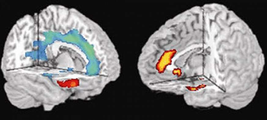 photo of MRI brain scans