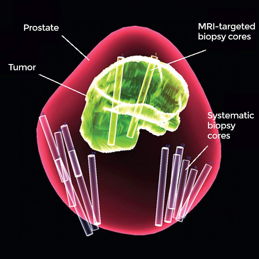 MRI-targeted biopsy cores in a tumor and 12 systematic biopsy cores elsewhere in a prostate