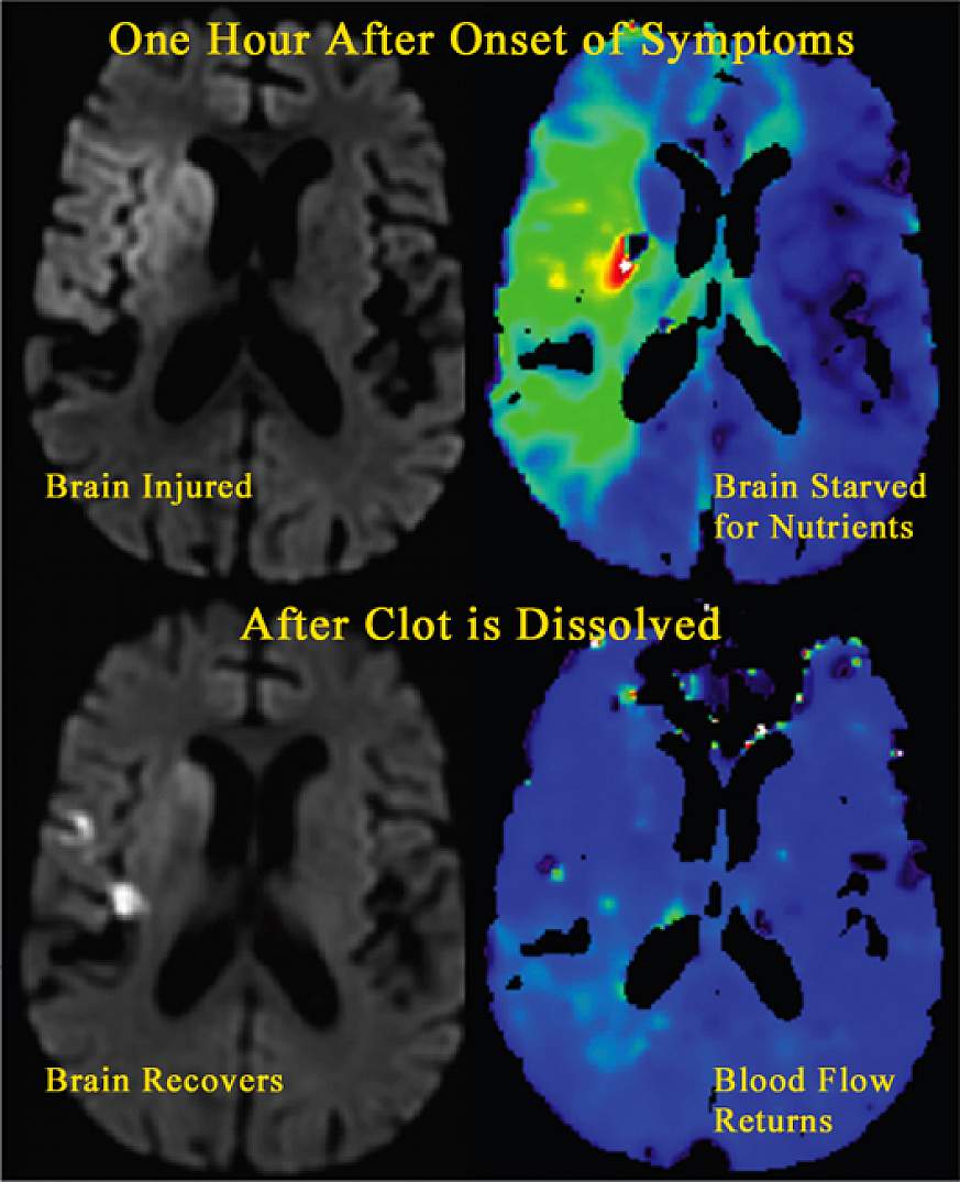 MRI images showing an ischemic stroke as it is happening and as it recovers.