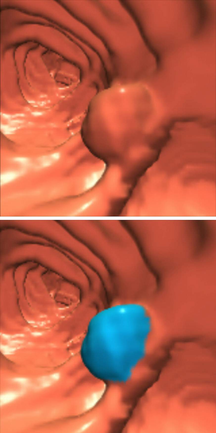 Computer generated image of a colon polyp.