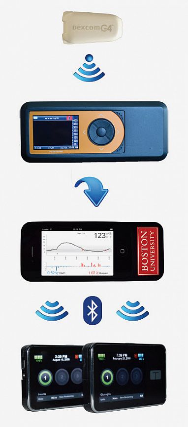 Pancreasul bionic tratează diabetul de tip 1 la adulți