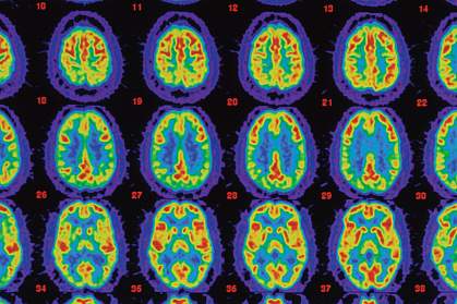 PET snímky porovnávající Alzheimerův mozek se zdravým mozkem.