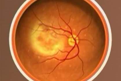In AMD, small yellowish deposits made partly of cholesterol form under the retina, blurring the sharp central area of vision. Image courtesy of NEI.