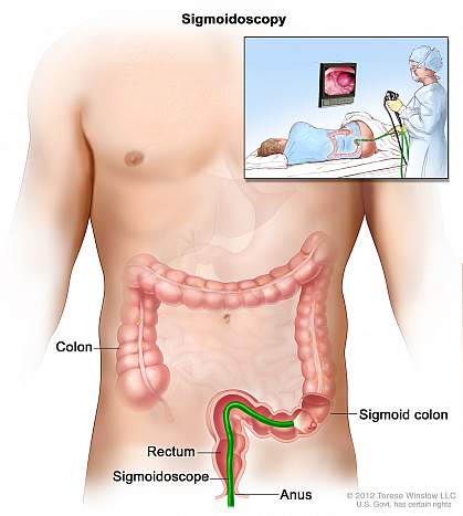 Artistic rendition of a sigmoidoscopy. Artistic rendition of a sigmoidoscopy.