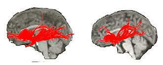 Image of normal brain scan vs. Williams syndrome.