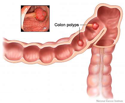 Image shows two polyps inside the colon.