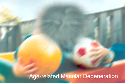 Age-related Macular Degeneration.