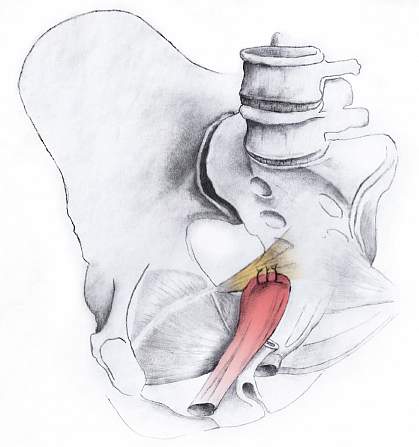 Sacrospinous ligament fixation.