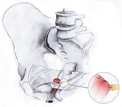 Uterosacral ligament suspension.