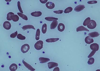 Image of blood from a sickle cell patient